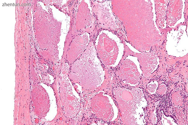 Intermediate magnification micrograph of pulmonary alveolar proteinosis. H&amp;E s.jpg