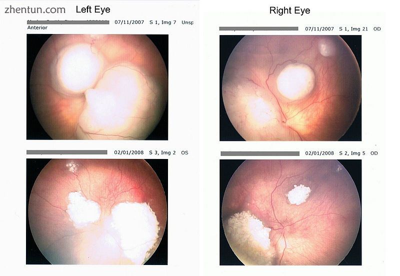 Rb tumors taken with a retinoscan before and during chemotherapy.jpg