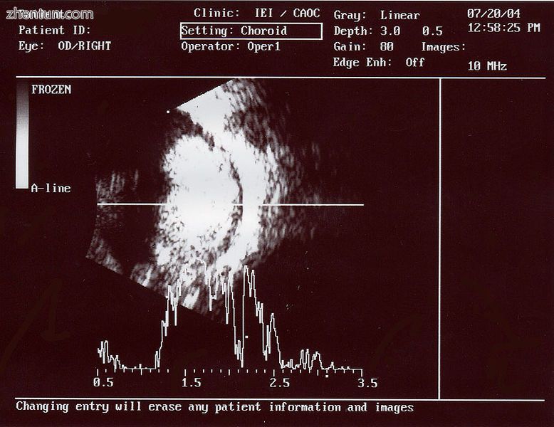 An ocular ultrasound of a large retinoblastoma tumor within the eye of a three-y.jpg