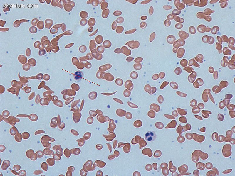 Sickle cells in human blood both normal red blood cells and sickle-shaped cells .jpg