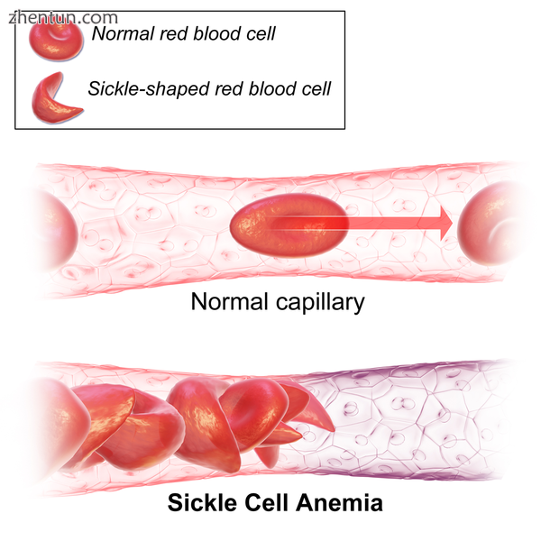 Sickle cell anaemia.png