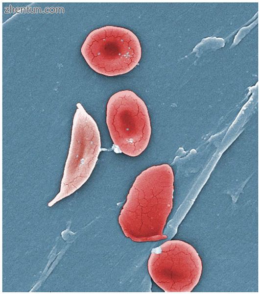 Normal blood cells next to a sickle blood cell, colored scanning electron micros.jpg