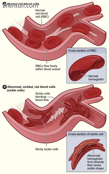 Figure (A) shows normal red blood cells flowing freely through veins. The.jpg