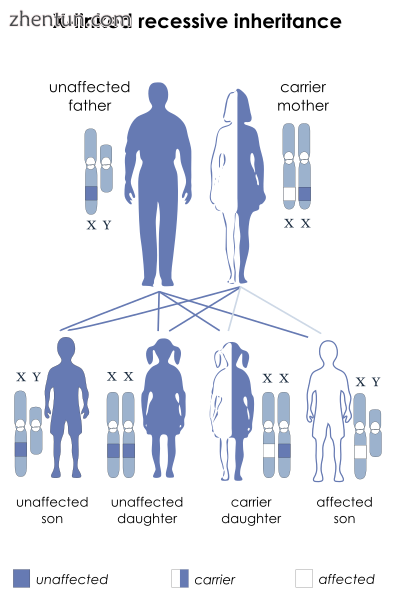 SBMA is inherited in an X-linked recessive pattern..png