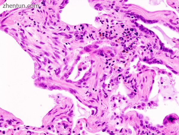 Micrograph of usual interstitial pneumonia (UIP). UIP is.JPG