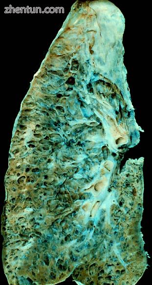 End-stage pulmonary fibrosis of unknown origin, taken from an autopsy.jpg