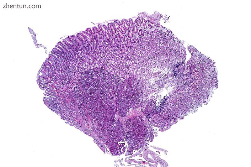 Stomach biopsy with pancreatic heterotopia in the submucosa. H&amp;E Stain..jpg