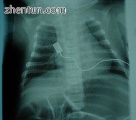 X-ray showing bell-shaped torso due to atrophy of intercostal muscles and using .jpg