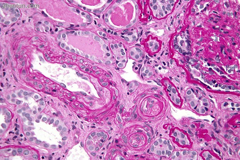 Micrograph showing thrombotic microangiopathy, the histomorphologic finding seen.jpg