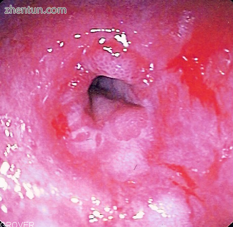 Endoscopic image of peptic stricture, or narrowing of the esophagus near the jun.png