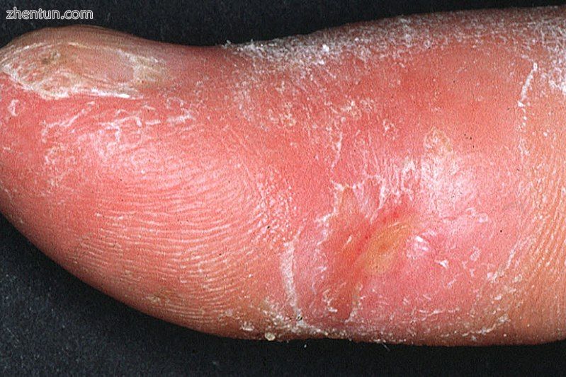 Clinical appearance of acrosclerotic piece-meal necrosis of the thumb in a patie.jpg