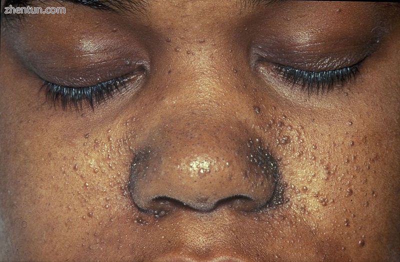 A case of tuberous sclerosis showing facial angiofibromas in characteristic butt.jpg