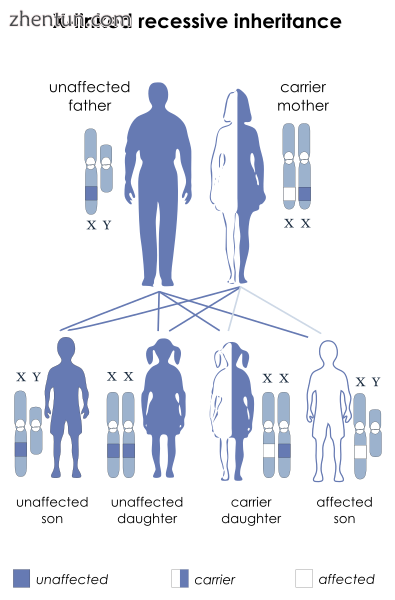 Wiskott–Aldrich syndrome has an X-linked recessive pattern of inheritance..png