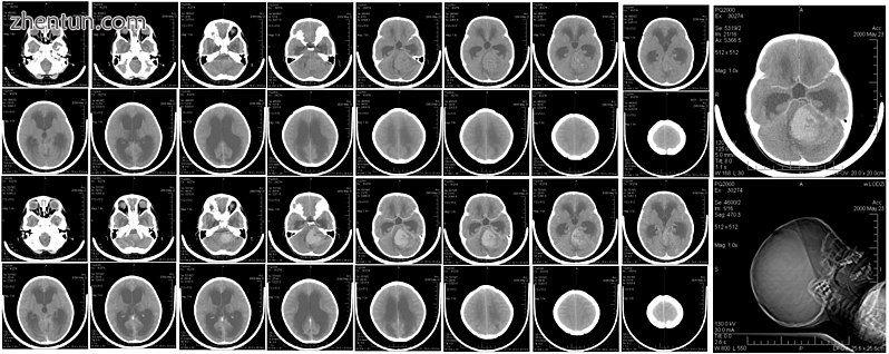 CT scan, showing a tumorous mass in the posterior fossa, giving rise to obstruct.jpg