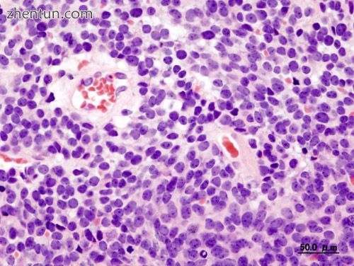 Cerebellar medulloblastoma in an adult2.JPG