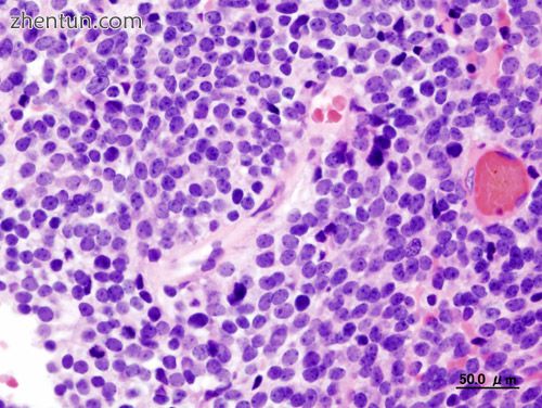 Cerebellar medulloblastoma in an adult.JPG