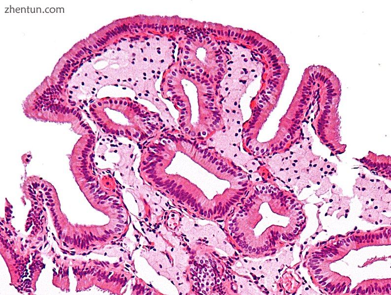 Micrograph of cholesterolosis of the gallbladder3.jpg
