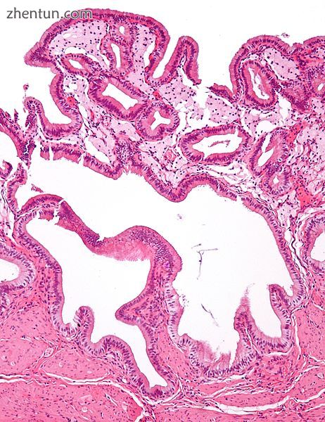 Micrograph of cholesterolosis of the gallbladder2.jpg