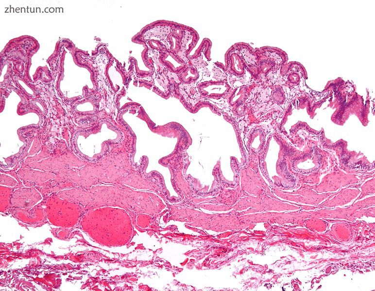 Micrograph of cholesterolosis of the gallbladder. H&amp;E stain..jpg