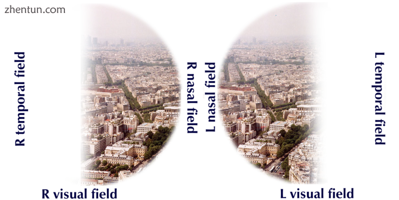 Visual field loss in bitemporal hemianopsia.png