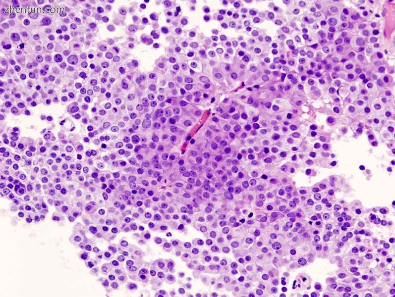 Nonfunctioning pituitary adenoma (1).jpg