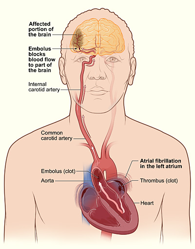 How a stroke can occur during atrial fibrillation.jpg