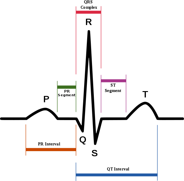 Diagram of normal sinus rhythm as seen on ECG. In atrial fibrillation the P wave.png