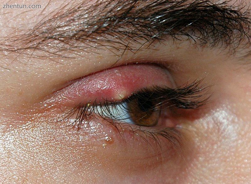 Eyelid affected by stye.jpg
