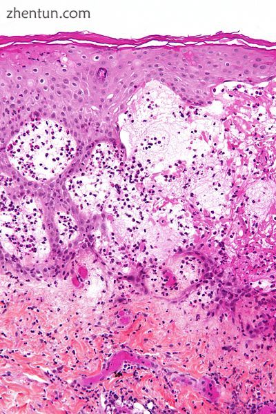 Micrograph of gestational pemphigiod showing the characteristic subepidermal bli.jpg