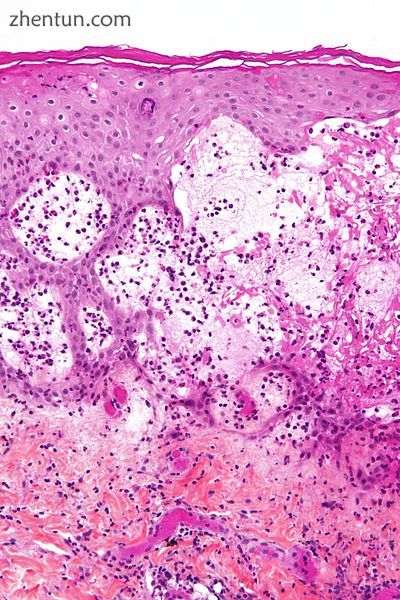 Micrograph of gestational pemphigiod showing the characteristic subepidermal bli.jpg