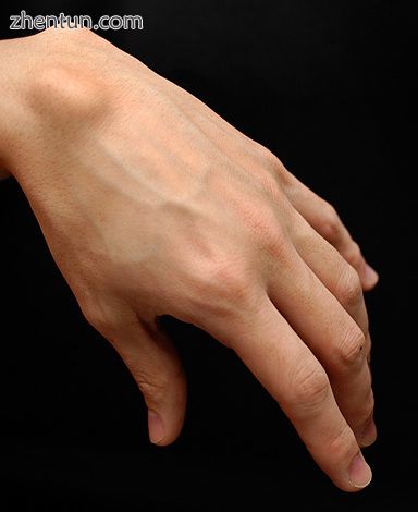 Cyst on dorsum of left hand close to the wrist.jpg