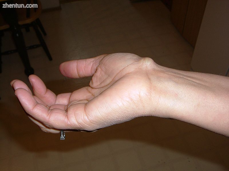 Cyst on right wrist.JPG