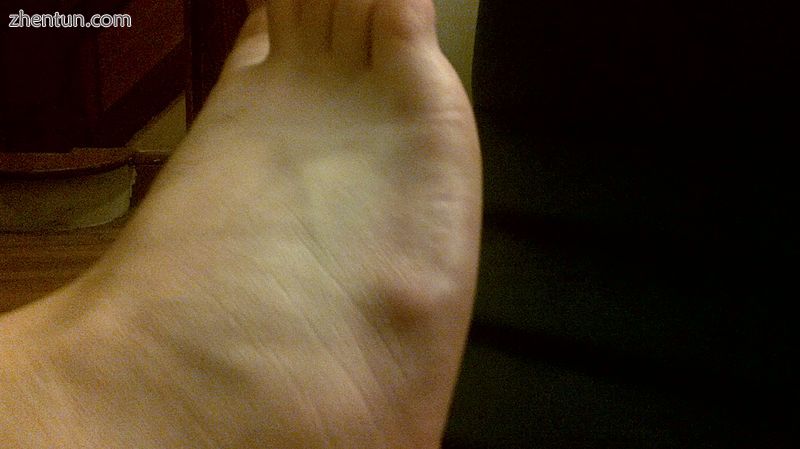 Cyst on dorsum of right foot.jpg