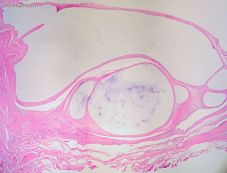 Ganglion cyst of the hand with multiple cystic chambers containing glairy materi.jpg