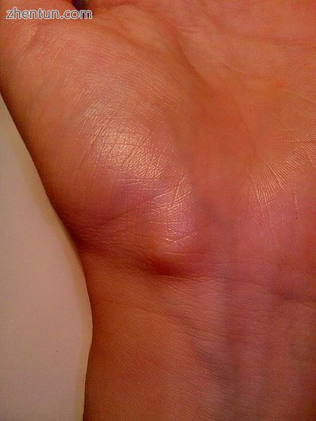 Ganglion cyst on the palmar side of the left wrist.jpg