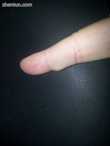 Small cyst on right index finger.jpg