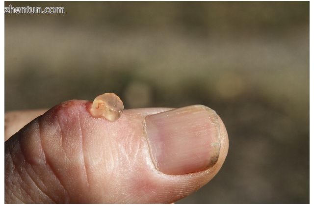 small cyst on thumb lanced with red-hot needle.JPG