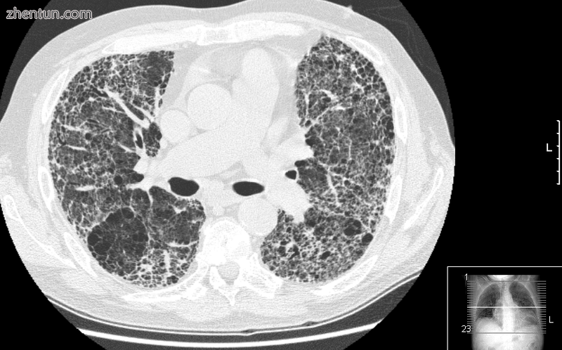 HRCT of lung showing extensive fibrosis possibly from usual interstitial pneumon.png