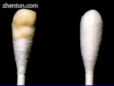 Mucopurulent cervical discharge seen on a cotton bud.png