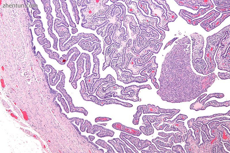 Micrograph of salpingitis – a component of pelvic inflammatory disease. H&amp;E s.jpg