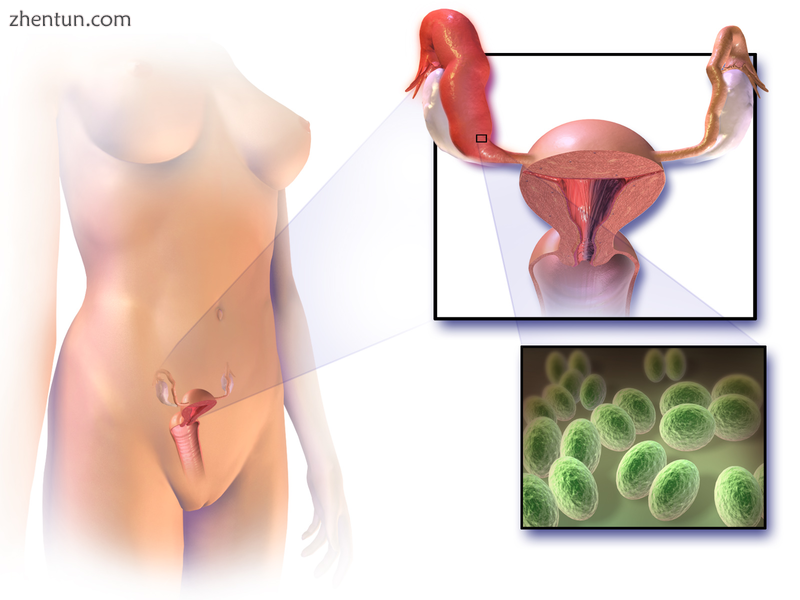 Illustration of pelvic inflammatory disease.png