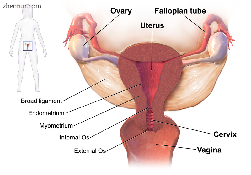 Drawing showing the usual sites of infection in pelvic inflammatory disease.png