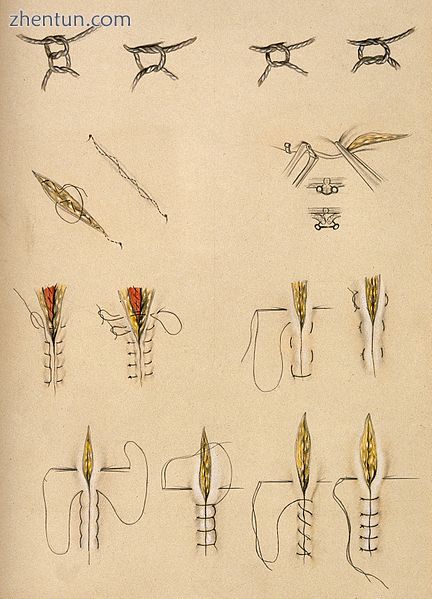 Historical diagrams illustrating various surgical stitches and knots.jpg