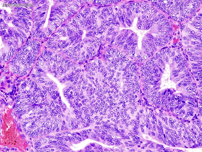 Endometrioid adenocarcinoma from biopsy. H&amp;E stain..jpg