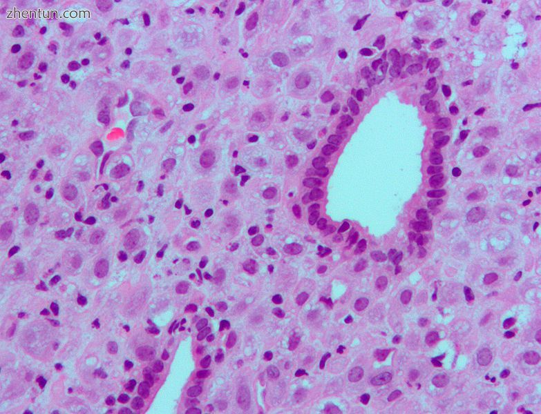 High magnification micrograph of decidualized endometrium due to exogenous proge.jpg