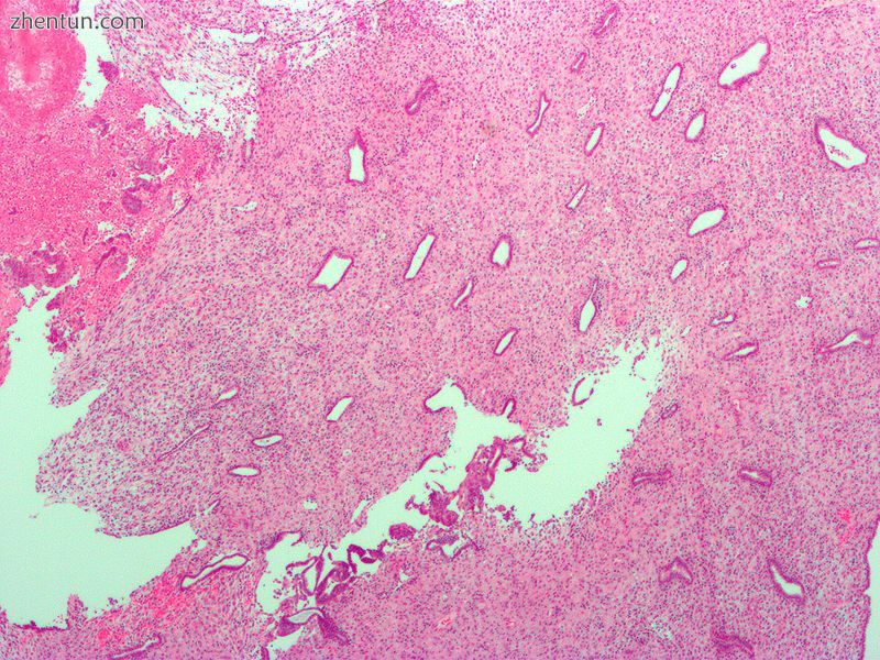 Low magnification micrograph of decidualized endometrium. H&amp;E stain.jpg