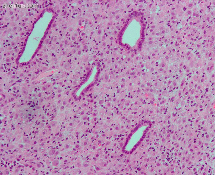 Micrograph of decidualized endometrium due to exogenous progesterone. H&amp;E stain..jpg