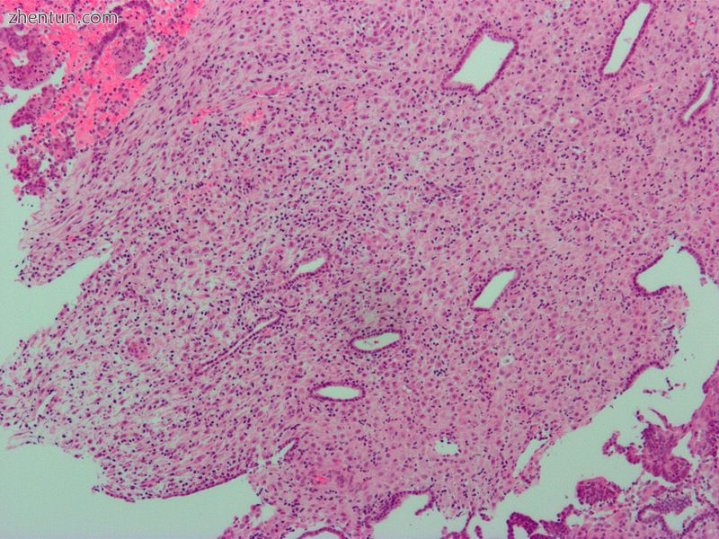 Micrograph of decidualized endometrium due to exogenous progesterone. H&amp;E stain.2.jpg