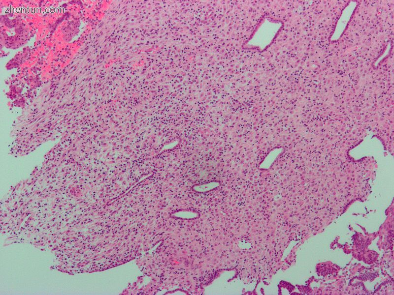 Micrograph of decidualized endometrium due to exogenous progesterone. H&amp;E stain.2.jpg