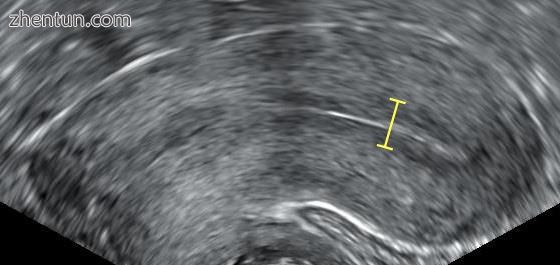 Triple-line endometrium measuring 7mm..jpg